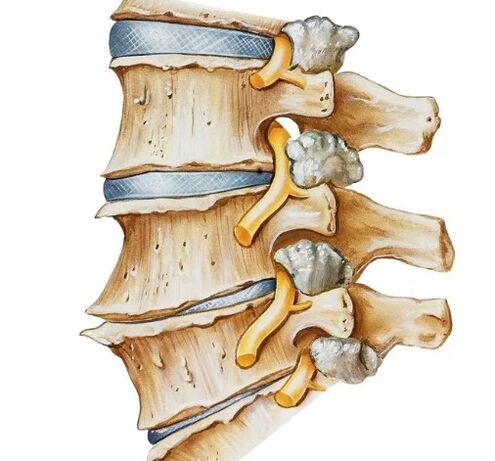 Nerve pinch in the spine