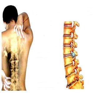 The stages of osteoarthritis