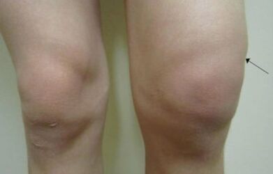 Clinical manifestations of knee joint disease