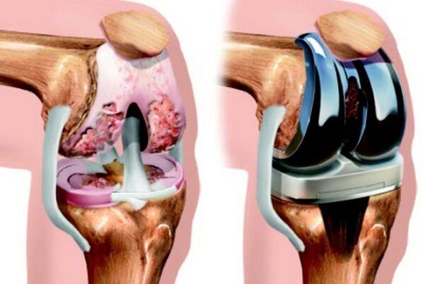 Before and after the interior of the knee joint to arthritis