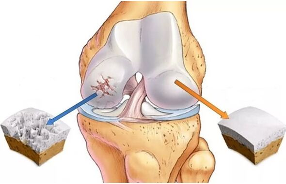Healthy cartilage and cartilage are affected by arthritis