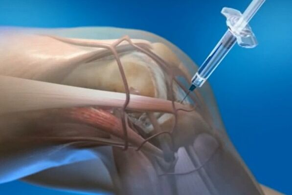 Organ injection for knee joints