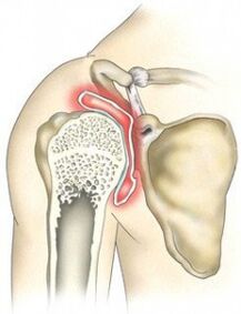 destruction of the shoulder joint due to arthritis