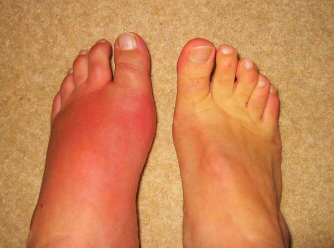 Leg pain due to gout