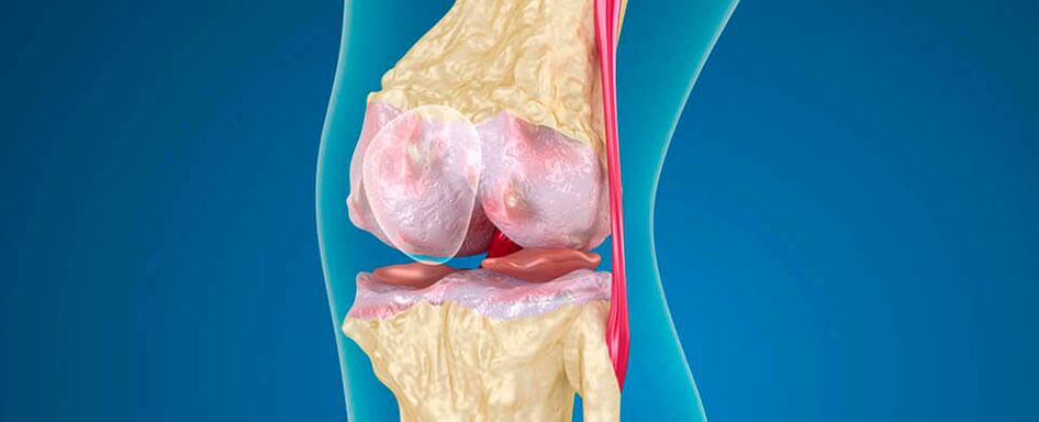 knee arthritis