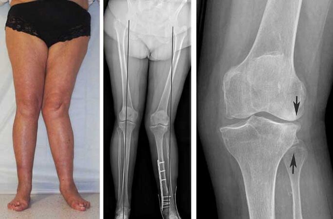 Advanced osteoarthritis of the knee joint