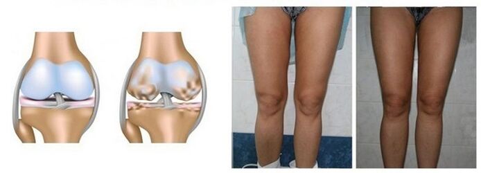 beat the dryness of the knee joint with the proof of the dry joint