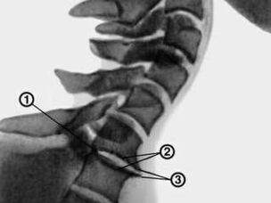Bone tumor in cervical spine with bone necrosis