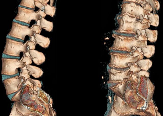 Spinal bone tumor on CT scan